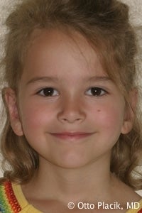 Otoplasty