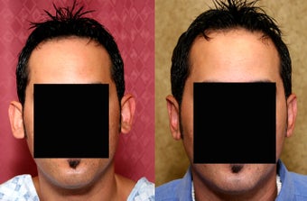 Otoplasty or ear push back surgery
