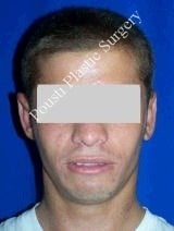 Ear Surgery (Otoplasty)