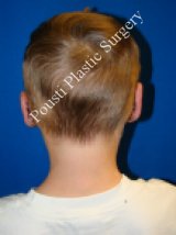 Ear Surgery (Otoplasty)