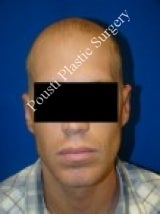 Ear Surgery (Otoplasty)