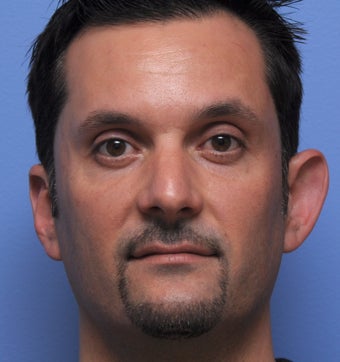Otoplasty