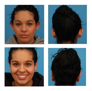 Otoplasty