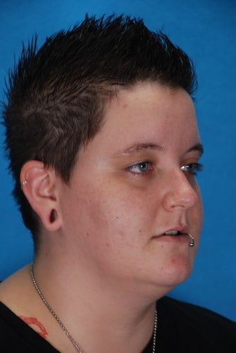 Ear Lobe Reconstruction