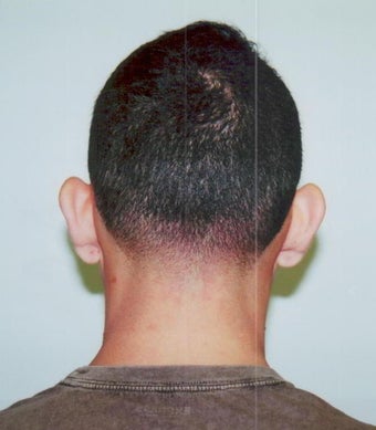 Otoplasty - Bilateral protruding ears