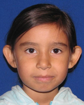 Otoplasty Ear Surgery