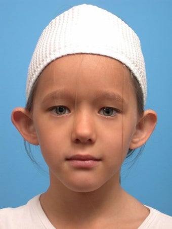 Otoplasty