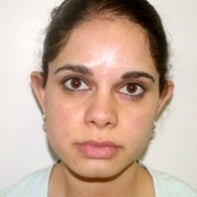 Otoplasty