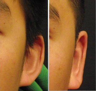 Ear Surgery - Otoplasty