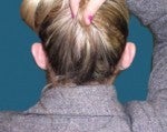 Ear Pinning