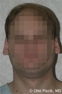 Otoplasty