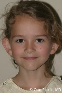 Otoplasty