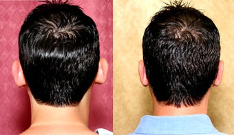 Otoplasty or ear push back surgery