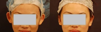Ear pinning Otoplasty