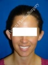 Ear Surgery (Otoplasty)