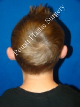Ear Surgery (Otoplasty)