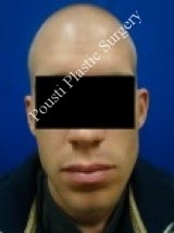 Ear Surgery (Otoplasty)