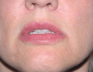 Injectables 