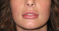 Injectables 