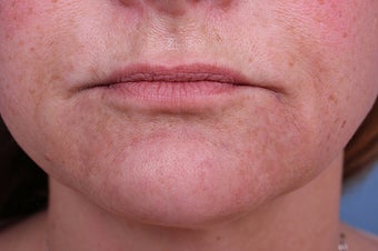 Evolence Collagen for Marionette Lines and Chin 
