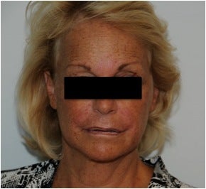Evolence Injection in Glabella to Reduce Static Wrinkles