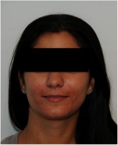 Evolence Injection in Smile Lines