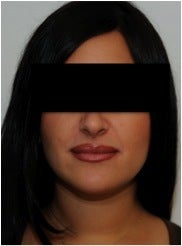 Evolence Injection Lips