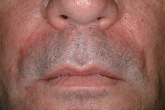 Evolence injections