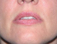 Injectables 