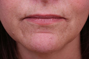 Evolence Collagen for Marionette Lines and Chin 