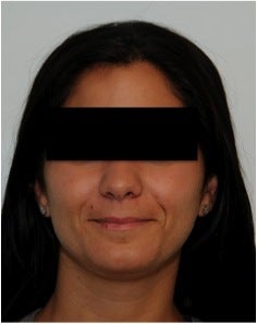 Evolence Injection in Smile Lines