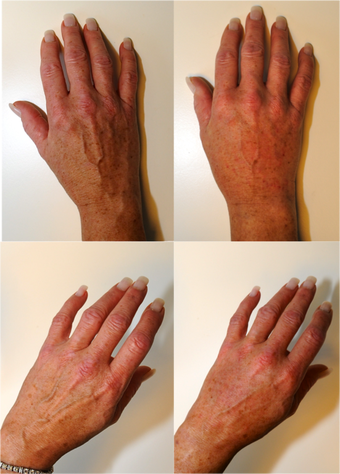 Hand Rejuvenation