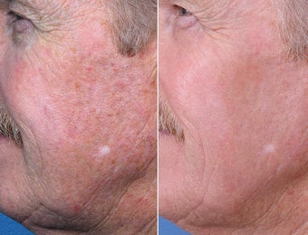 Evolence Chin and Smile Lines