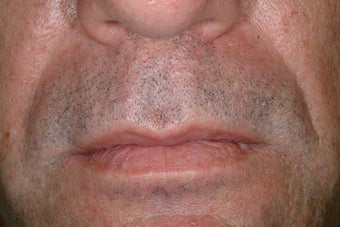 Evolence injections