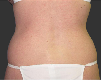 Exilis