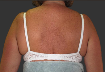 Exilis