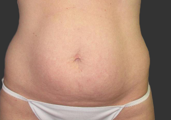 Exilis