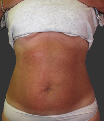Exilis