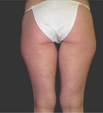 Exilis