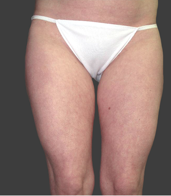 Exilis