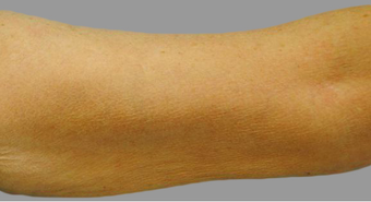 Exilis