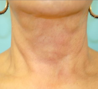 Exilis