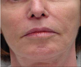 Exilis