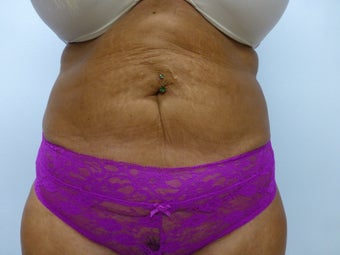 Exilis for skin tightening on post liposuction patient