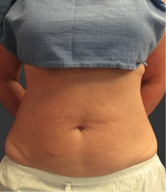 Exilis