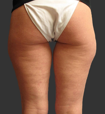 Exilis