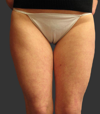 Exilis