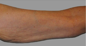 Exilis
