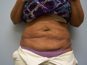 Exilis for skin tightening on post liposuction patient