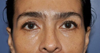 Lower lid blepharoplasty and Fat Transfer to lower lids and midface